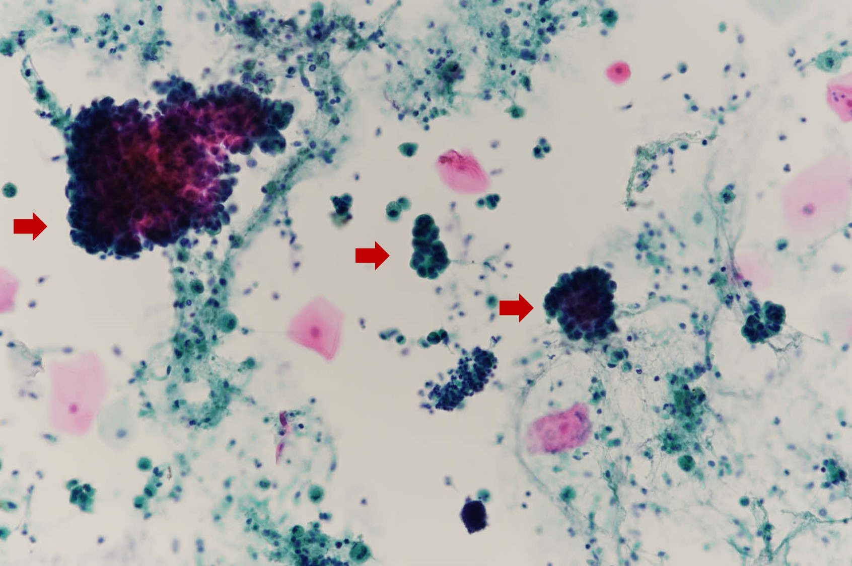 +Bronchialwashing-X400-1_202501269320646.jpg