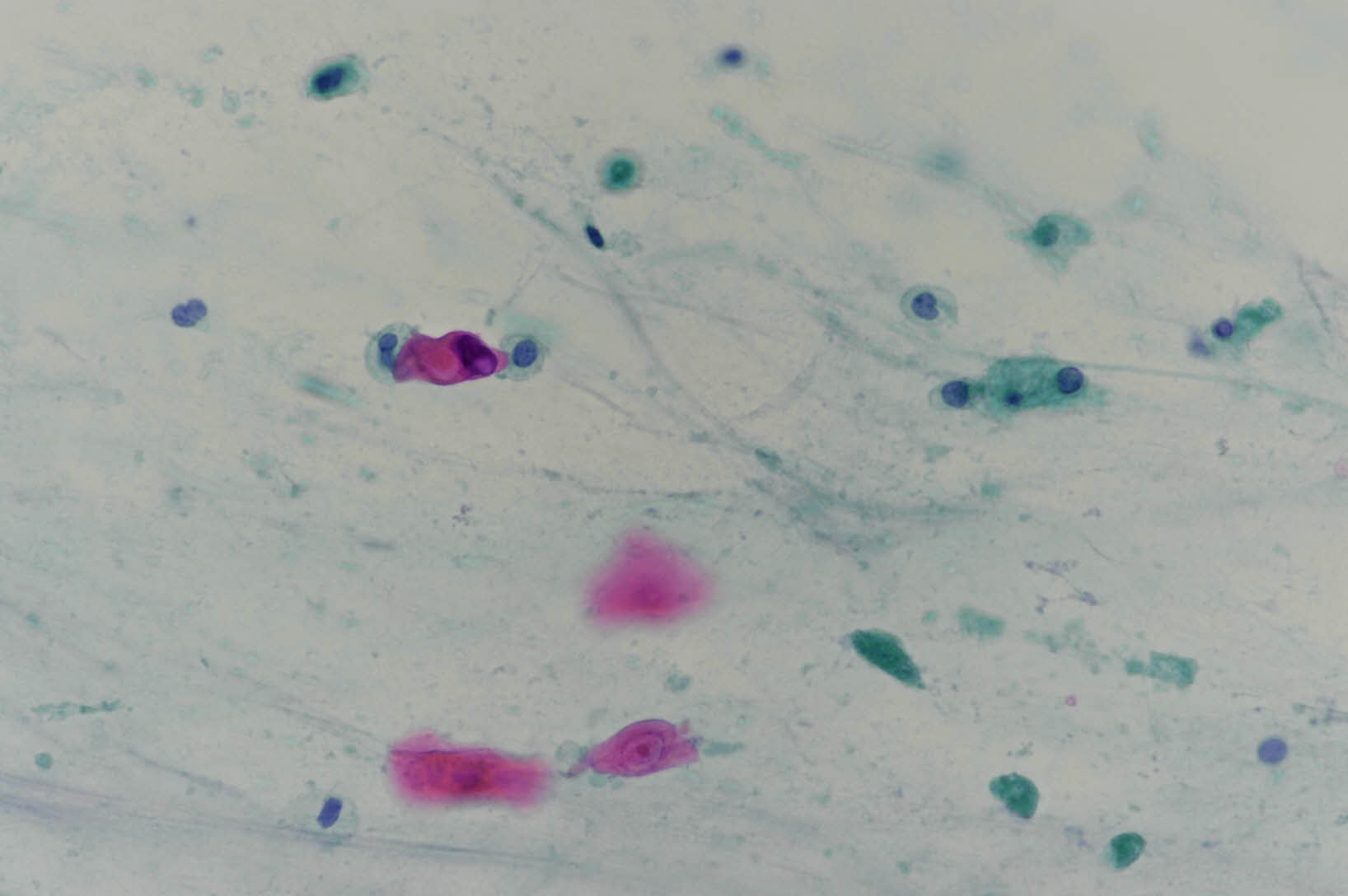 +NG25-855sputum-atypiafavorneoplastic-x400-1_202503292155988.jpg