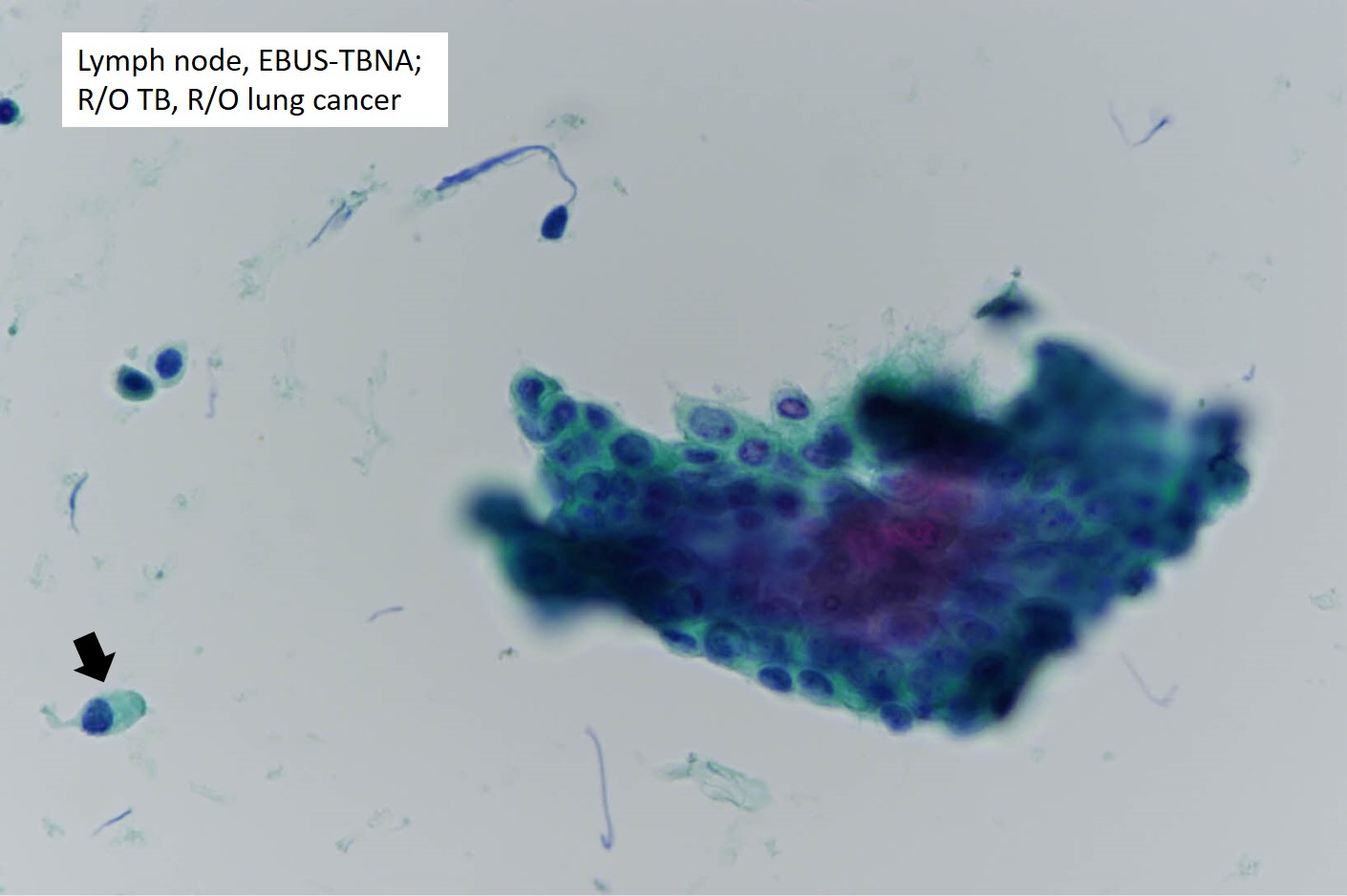 ABC24-1888EBUS-TBNA-reactivebronchialcells-3_20250112111629732.jpg