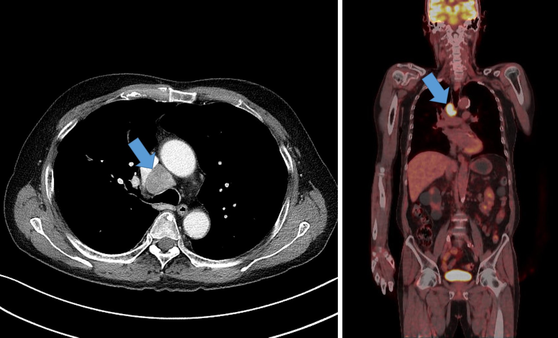 ChestCT-PETCT-1_202503982728891.jpg