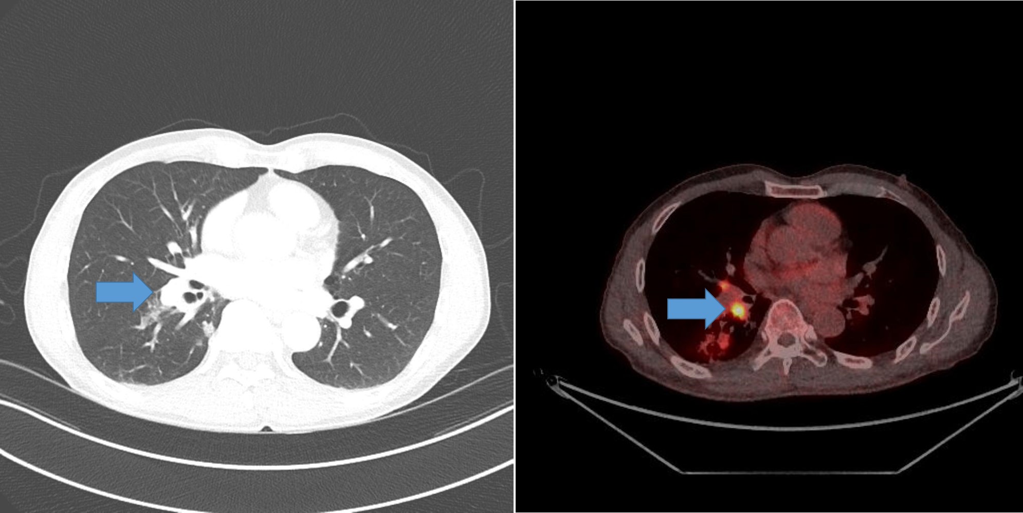 ChestCT-PETCT-1_20250398476168.jpg