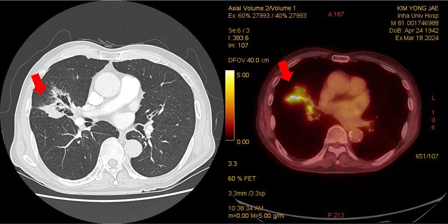 ChestCTandPETCT_2025032045375.jpg