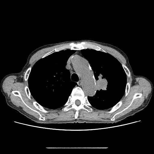 H25-385-SqCCa-chestCT0055_202503292927487.jpg