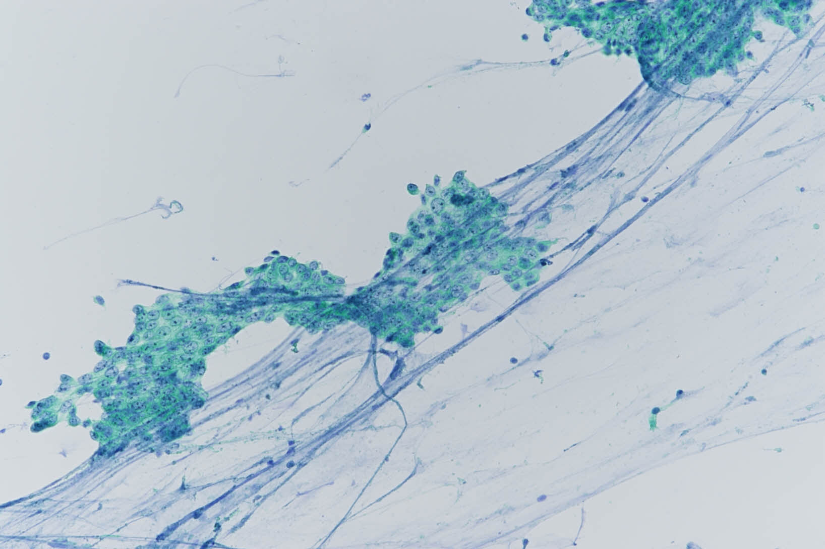 NG24-7963sputum-reactive-x200-1_202503291911725.jpg